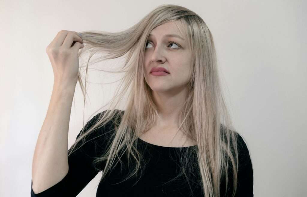 dandruff
